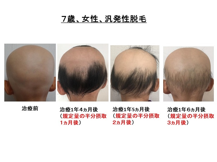 円形脱毛症　病院